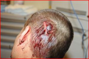 Agent McFarlane’s head, lacerated when Todashev allegedly hit him with a table. 