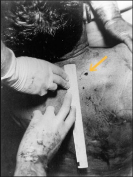 JFK, back wound, autopsy