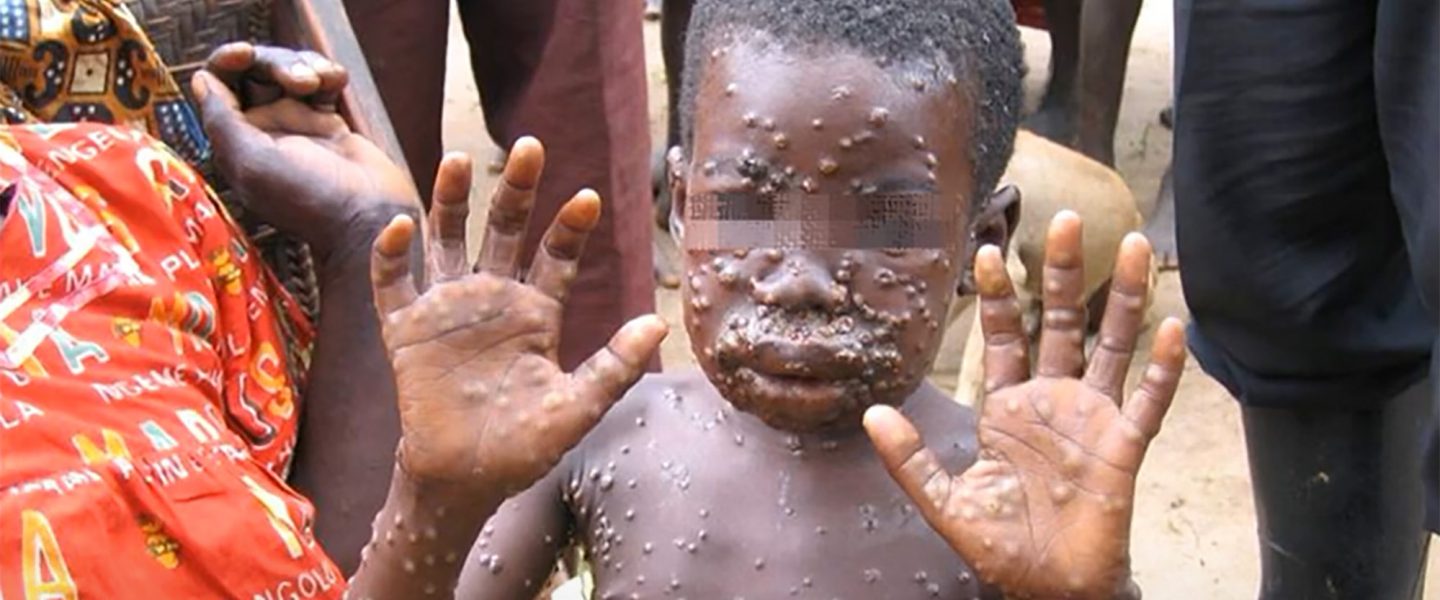 boy, monkeypox, Africa