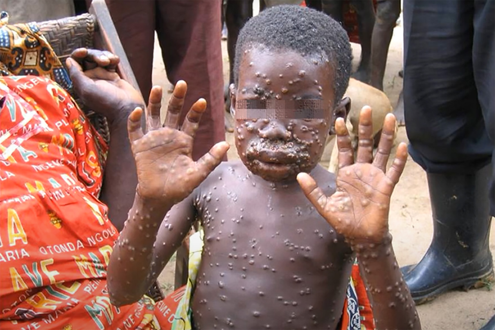 Monkeypox Is Spreading — Better Mask Up