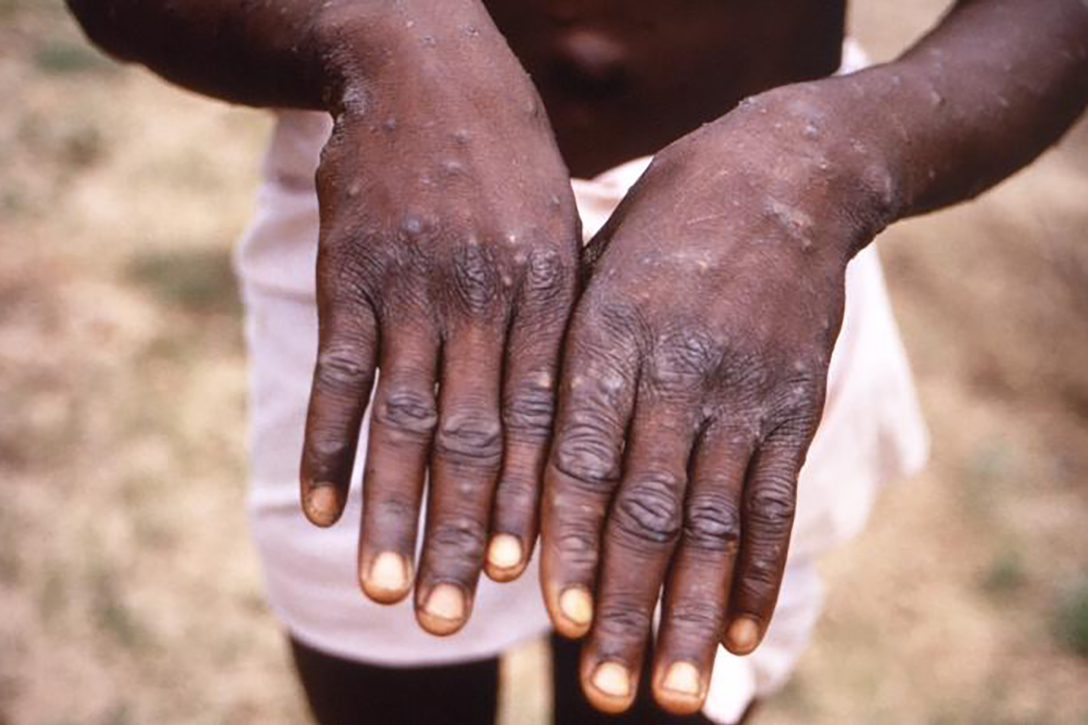 Monkeypox, lesions, hands