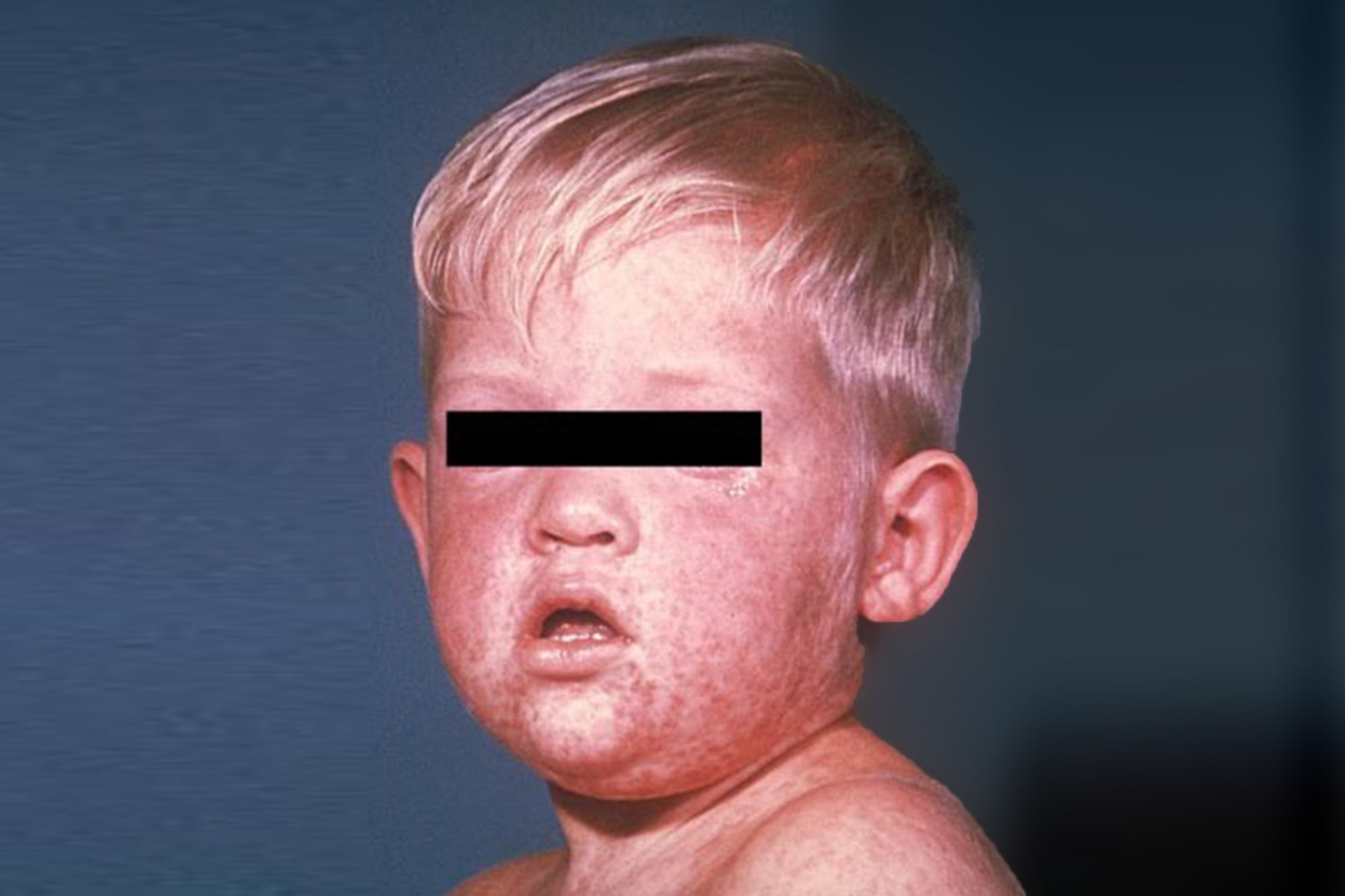 measles, blemishes