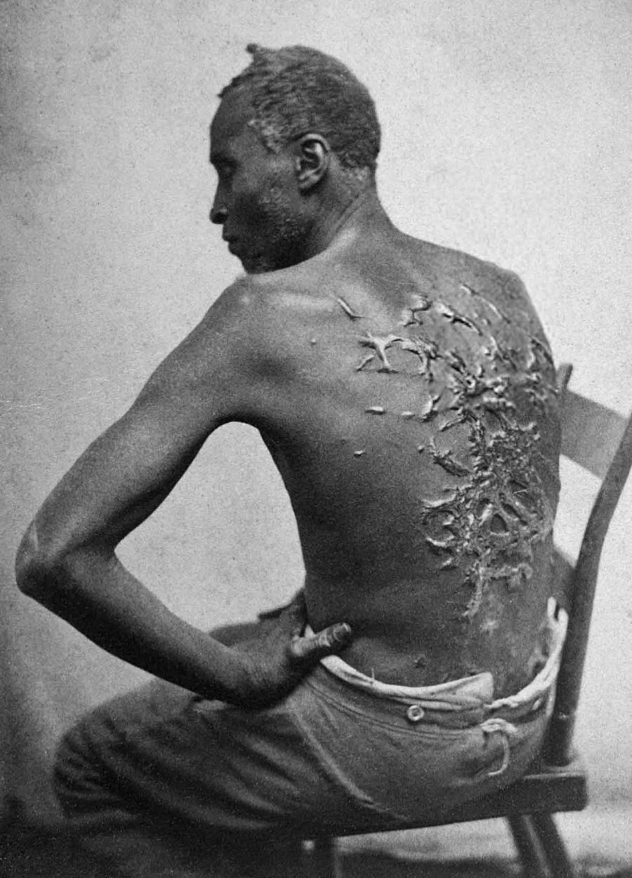 Peter, whipped, enslaved man, 1863.